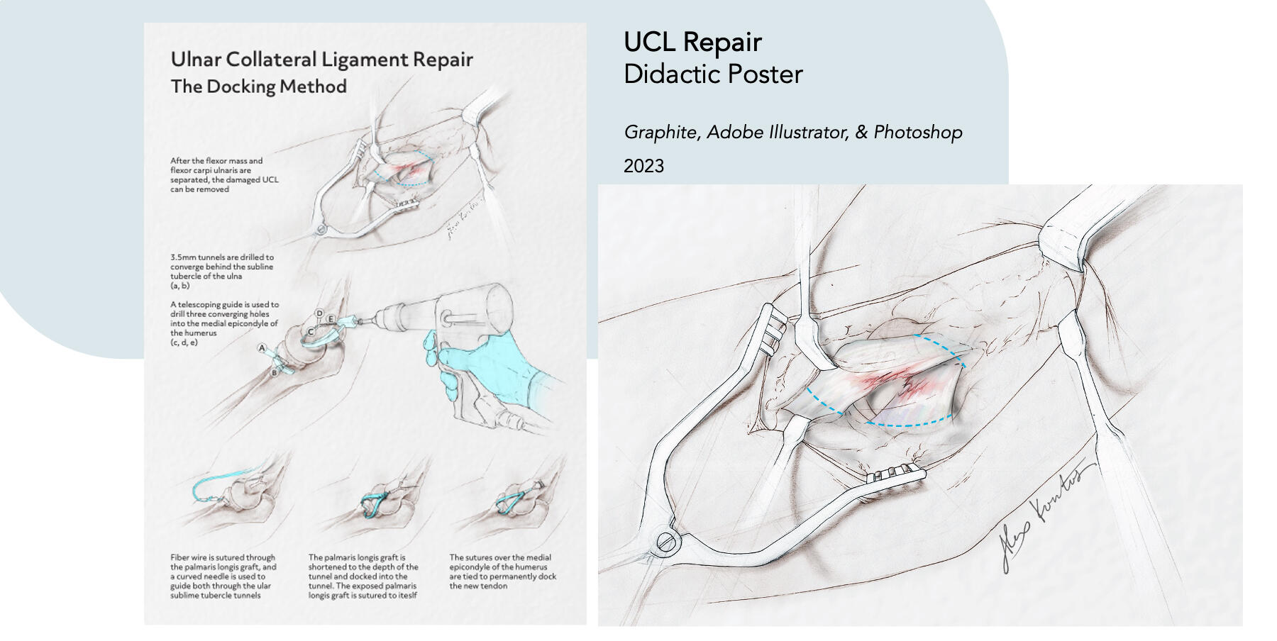 UCL Repair